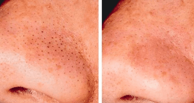 Maschera fai da te contro i punti neri: ricetta naturale ed efficace per una pelle pulita