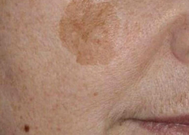 Hai mai provato a schiarire le macchie scure del viso con i rimedi naturali?