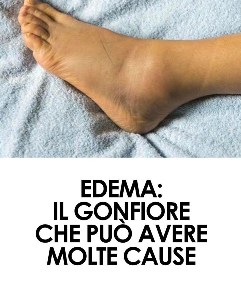 Edema: un gonfiore che può avere molte cause