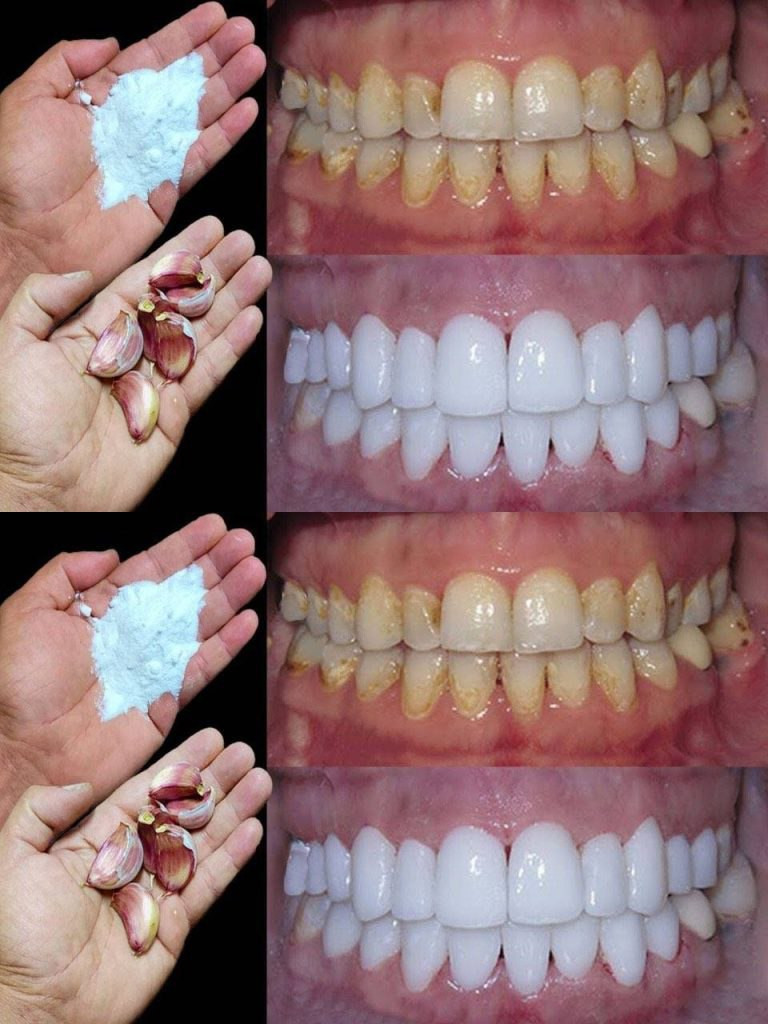 Come sbiancare i denti in 2 minuti?