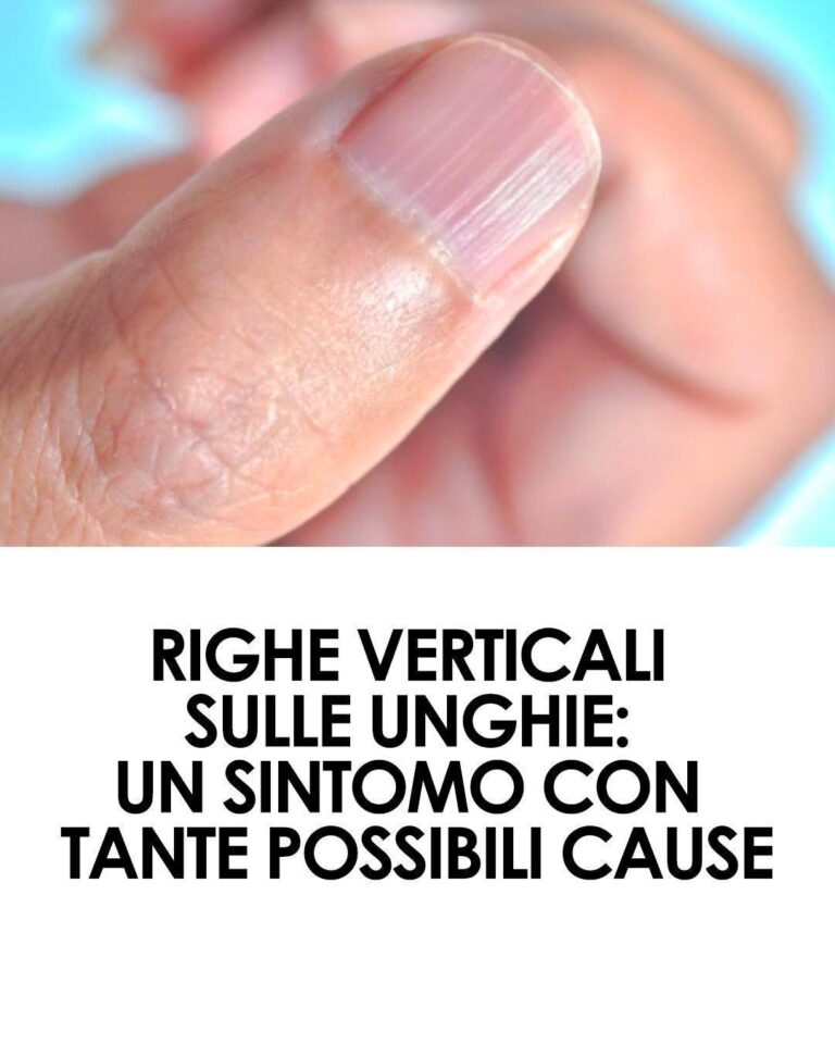Righe verticali sulle unghie: un sintomo con tante possibili cause