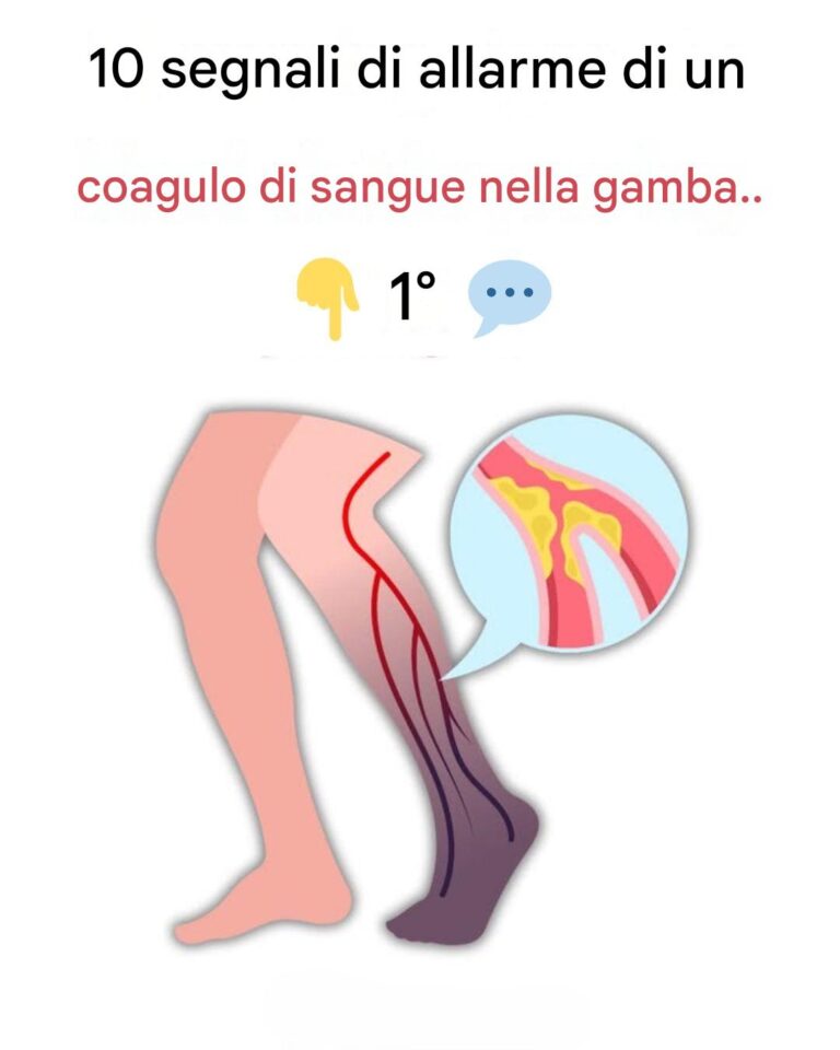 10 segnali di avvertimento di un coagulo di sangue nella gamba che dovresti conoscere